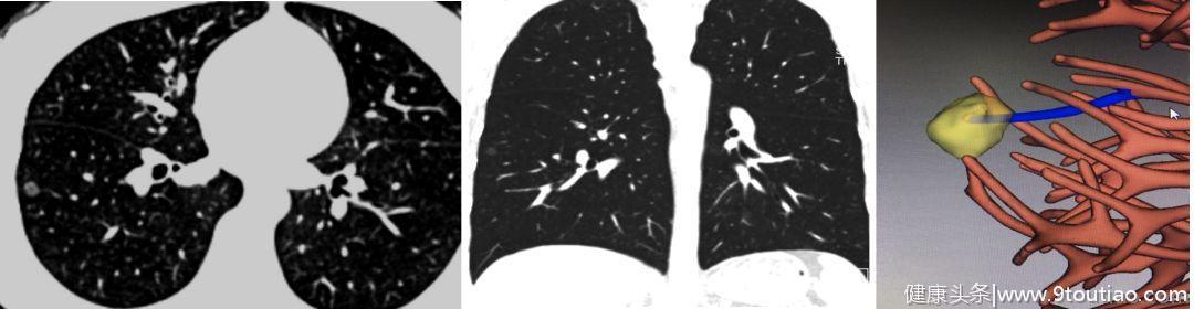 5年生存率达100％的早期微小肺癌却极易误诊为炎性结节？