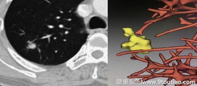 5年生存率达100％的早期微小肺癌却极易误诊为炎性结节？