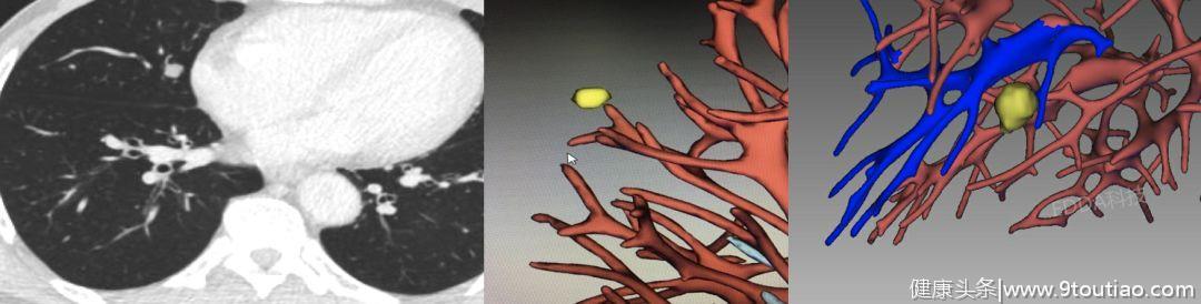 5年生存率达100％的早期微小肺癌却极易误诊为炎性结节？