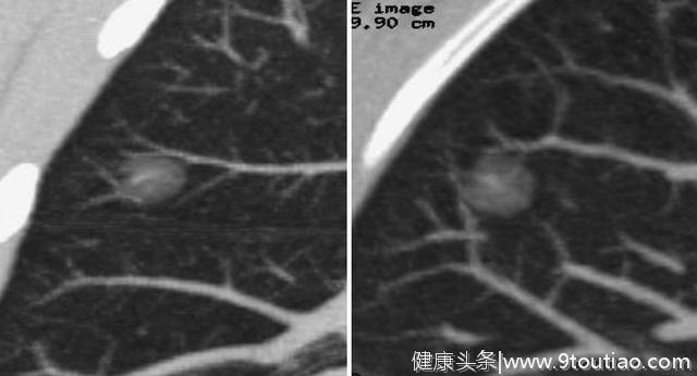 5年生存率达100％的早期微小肺癌却极易误诊为炎性结节？