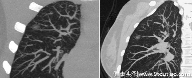 5年生存率达100％的早期微小肺癌却极易误诊为炎性结节？