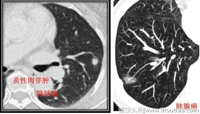 5年生存率达100％的早期微小肺癌却极易误诊为炎性结节？