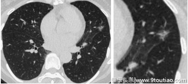 5年生存率达100％的早期微小肺癌却极易误诊为炎性结节？