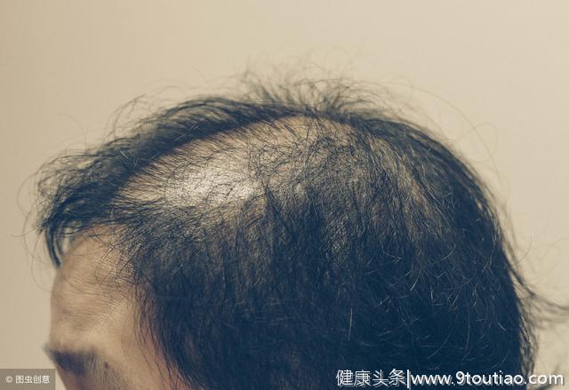 95%的男性脱发是雄激素源性脱发，男性脱发影响性能力？ 听听专家怎么说
