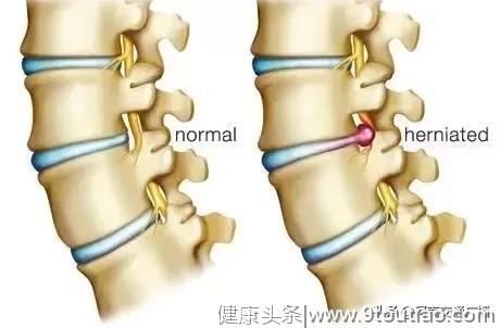 “这哪是23岁的腰”瑜伽教练严重椎间盘突出!这项运动不是人人都能练