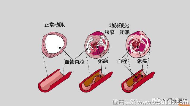 冠心病人适合哪些饮食方式？不健康的饮食有哪些？