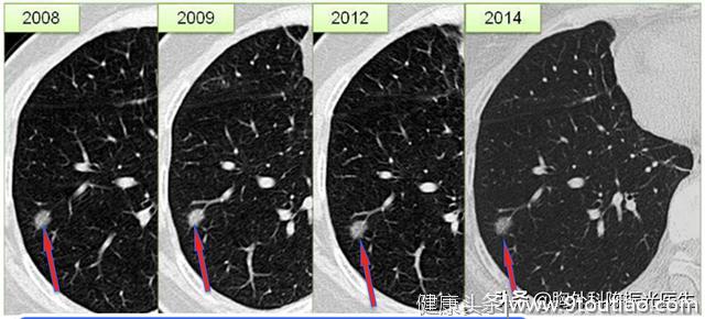 得了肺结节都担心是肺癌？从CT报告中你也可以了解恶性的可能性