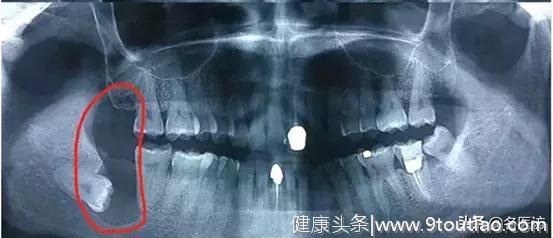 为什么牙医要我们拔智齿？孕妇智齿不拔，引发感染危及生命