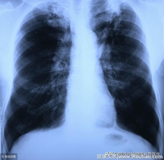 哮喘慢阻肺重叠综合征的治疗方法，哮喘慢阻肺研究仍任重而道远