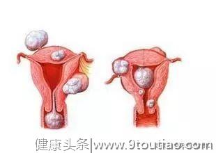 子宫肌瘤对女性怀孕有哪些影响?