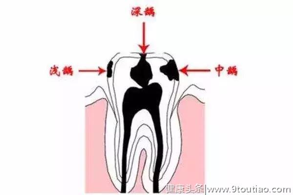 每年都要做的【口腔检查】到底是检查什么？