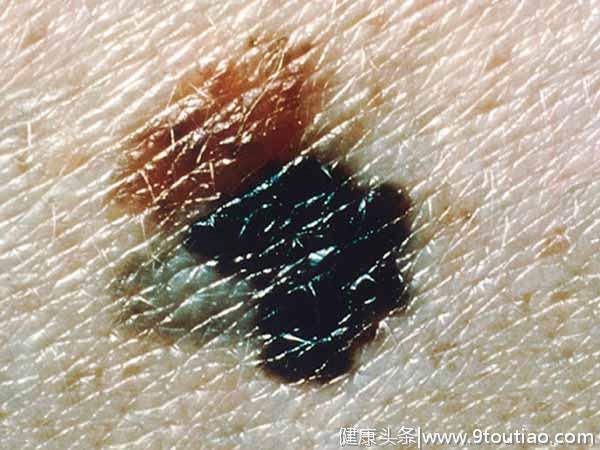 再次提醒：皮肤上出现这6种痣，小心皮肤癌