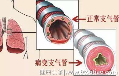 得了哮喘，吃药比吃饭重要