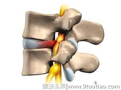 骨科医生：怎么预防骨质增生引起的腰腿疼痛？