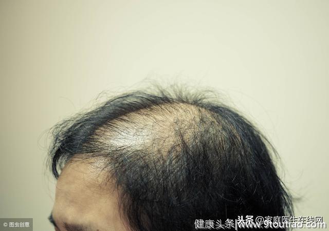 3个原因不重视，脱发会越来越严重，头上不剩一根毛
