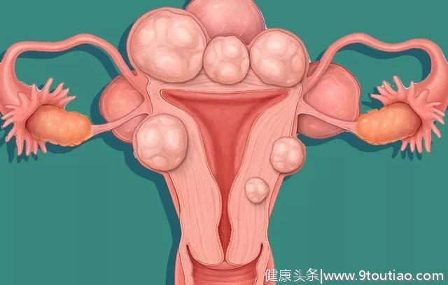 为什么多囊女性更容易得子宫肌瘤？