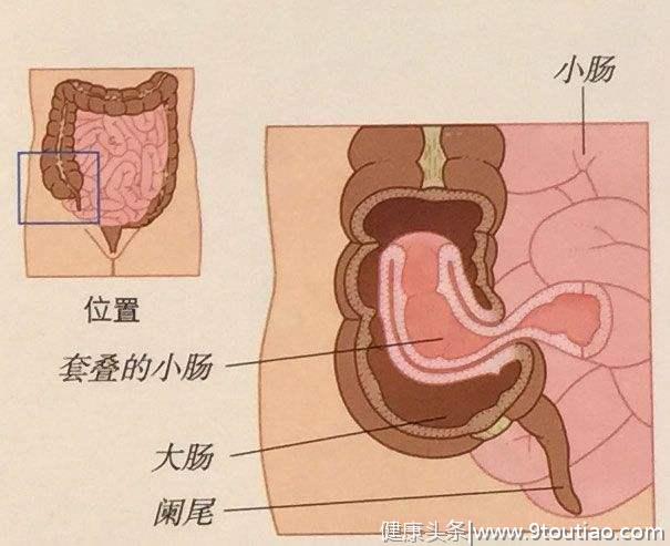 肠套叠，父母应该知道的婴幼儿常见病。