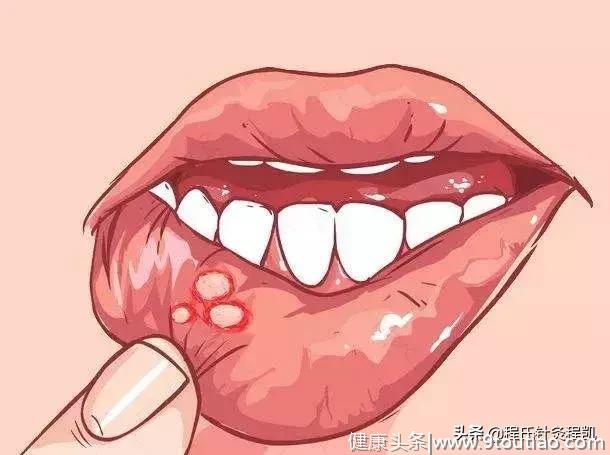 春季口腔溃疡疼痛难忍，反复发作？中医专家支招对付它