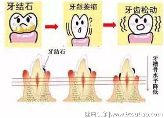 洗牙真的会对牙齿产生伤害吗？口腔医生告诉你