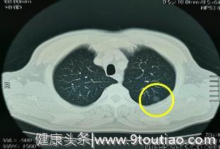 在我们的临床检查中，哪些是肺癌的主要标志物？