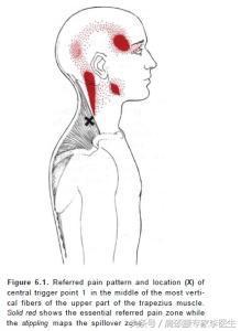 李医生：颈椎病经常头痛怎么办？教你3个方法斩断头痛