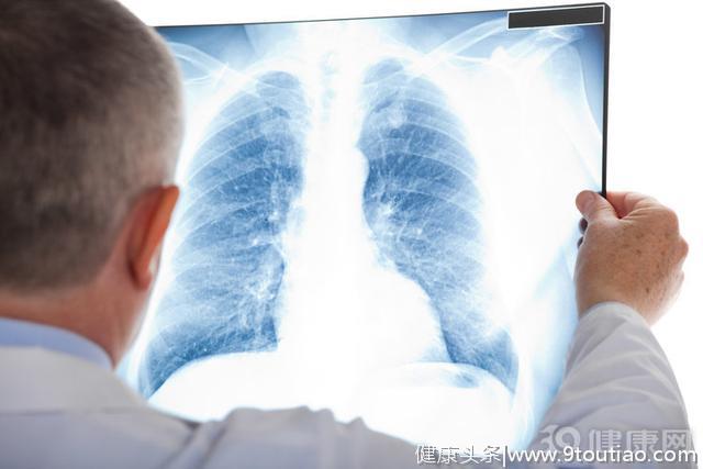 查出肺结节，就是得肺癌？满足这4大情况，才好下定论！
