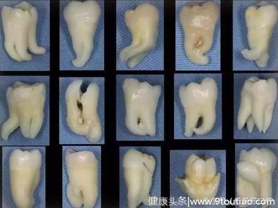 做了半辈子牙医可能都没见过的牙齿情况！