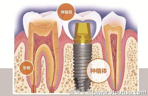 四大理由告诉你为什么牙齿缺失之后一定要选择种植牙！