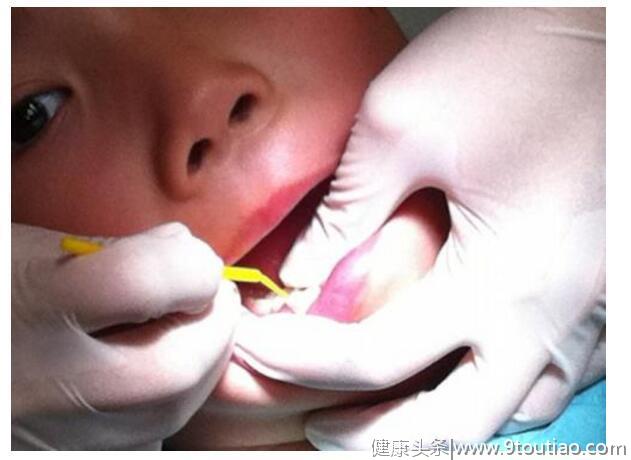 儿童牙医詹磊：儿童牙齿烂掉只剩牙根怎么处理？