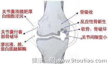 骨质增生是不是个病？和骨质疏松症有啥关系？骨科医生说了大实话