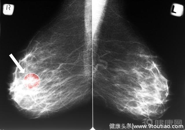 乳房肿块担心是癌？3种方法把它查的明明白白！