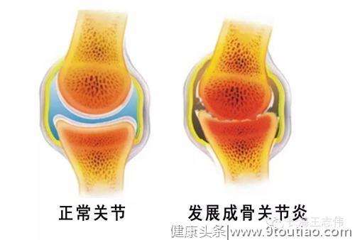 运动伤关节？研究表明：运动有助于防止由骨关节炎引起的软骨退化