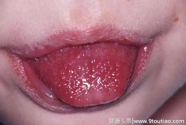 眼唇红、草莓舌、出疹子、手足肿，这种疾病可能要了娃儿的命