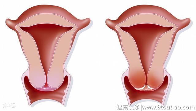 出现哪些异常预示宫颈癌已经发展到晚期呢