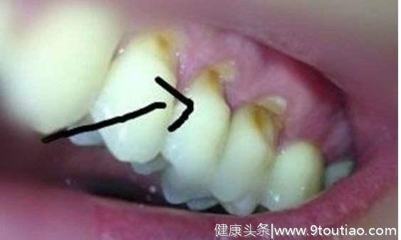 牙釉质是怎么被破坏的？
