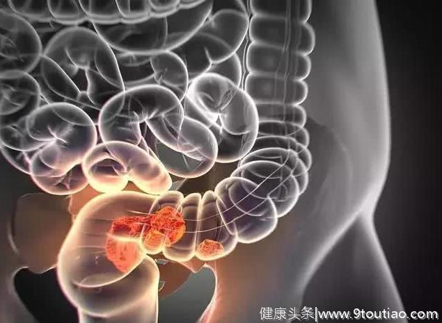 29岁小伙腹泻查出肠癌，医生惋惜：这2样东西，害了不少年轻人！