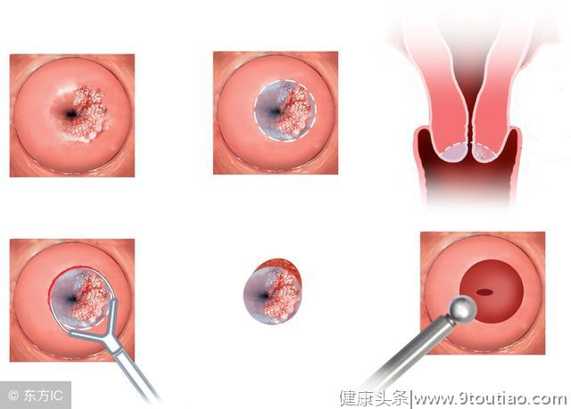 宫颈癌有什么明显症状？每人都记住这几点知识吧