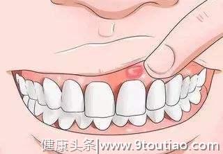 口腔溃疡反复发作太痛苦，5大病因需了解！