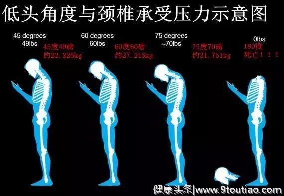 手机是玩爽了，你的颈椎可遭罪了！看看手机脖的严重性！