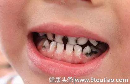 “十个儿童，八个黑牙” 牙色改变意味着孩子口腔出了问题！