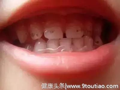 “十个儿童，八个黑牙” 牙色改变意味着孩子口腔出了问题！
