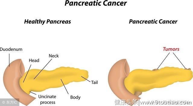 四个症状不断出现，十有八九是胰腺癌，最好去检查一下