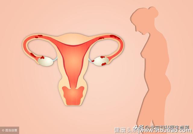 女性健康的隐患--你有子宫腺肌症么？
