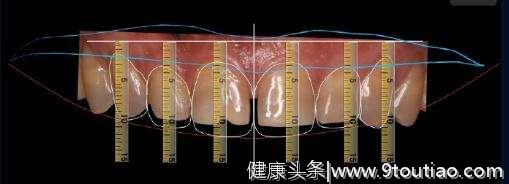 揭秘牙科暴利：十几块的牙贴面，凭啥医院要叫价千元一片？