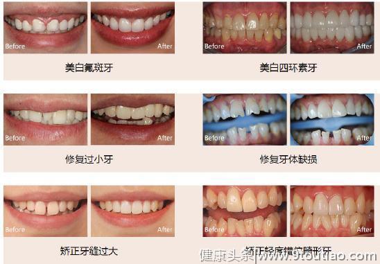 揭秘牙科暴利：十几块的牙贴面，凭啥医院要叫价千元一片？