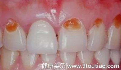 什么是牙齿脱矿 原因与疗法你都知道吗？