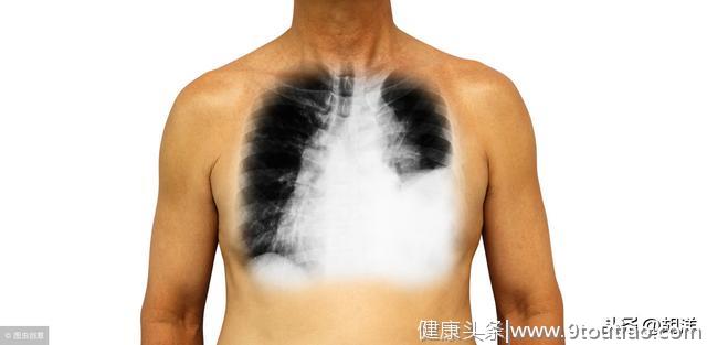 肺里抽出血水八成是肺癌，一旦水里找到癌细胞就是晚期，生存期短
