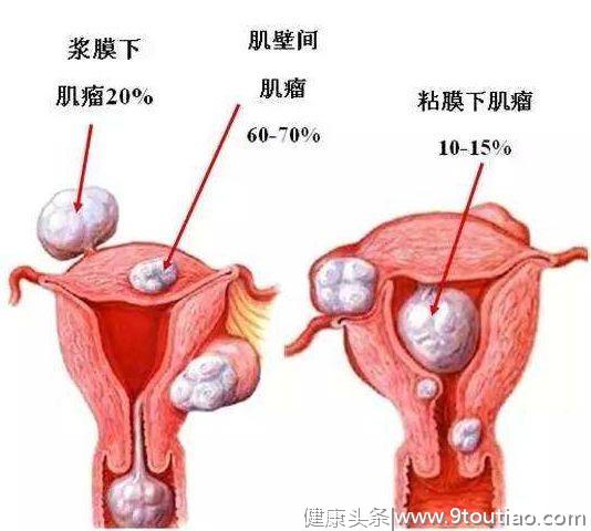 子宫肌瘤手术后并不会都痊愈，还可能复发！