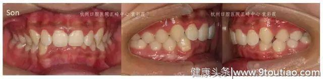 很多人都有！牙齿的深覆合需要重视#葉子口腔科普#