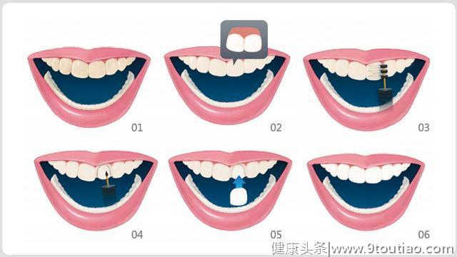 4种牙齿美白疗程，让你不再一口黄牙